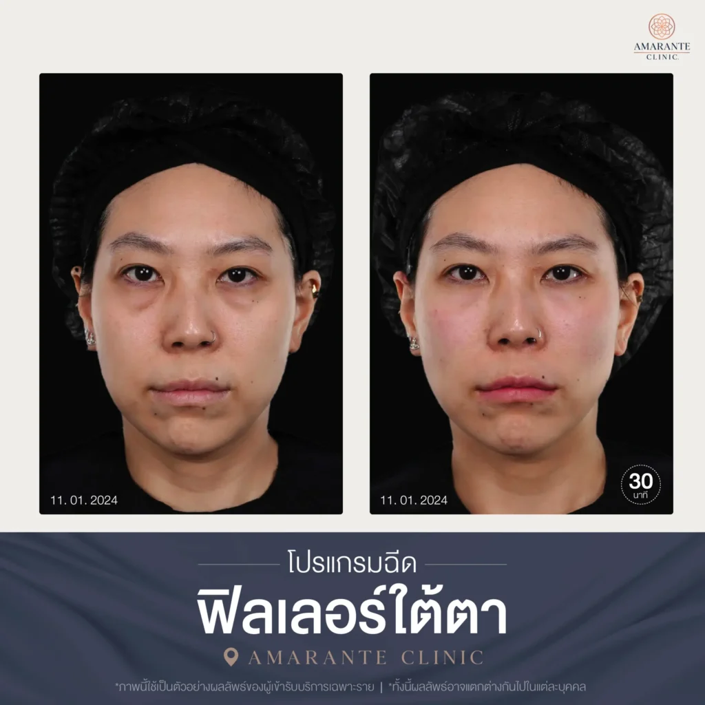 โปรแกรมฉีดฟิลเลอร์ใต้ตา-06-scaled