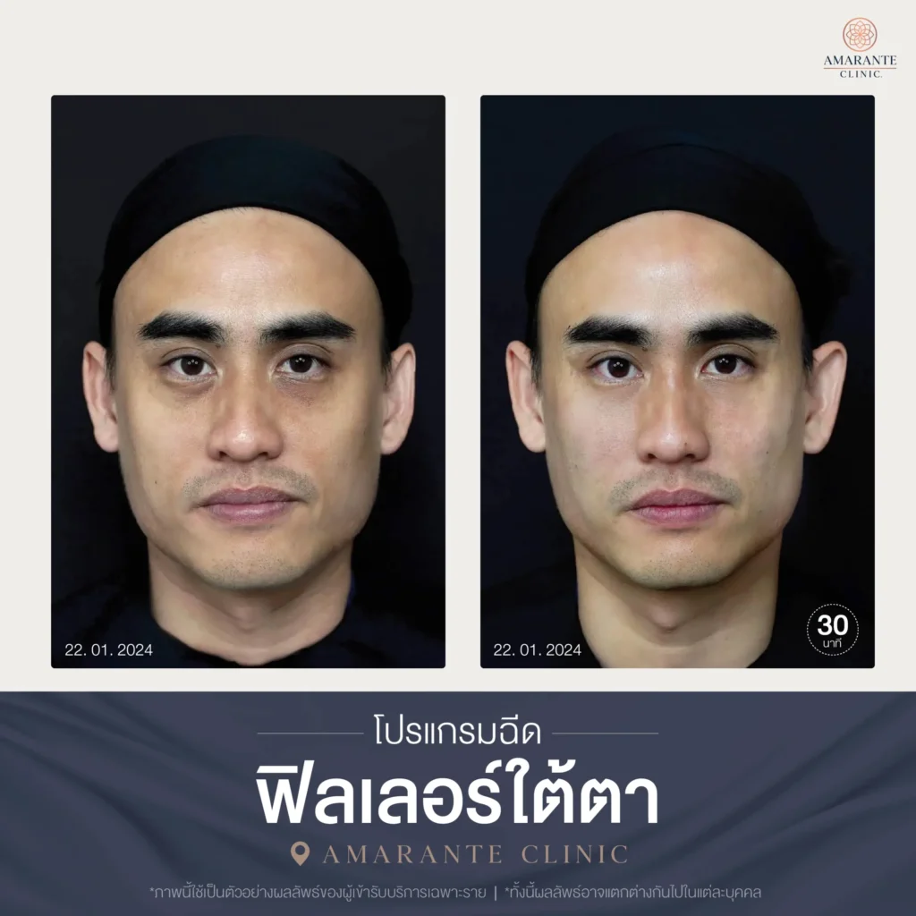 โปรแกรมฉีดฟิลเลอร์ใต้ตา-07-scaled