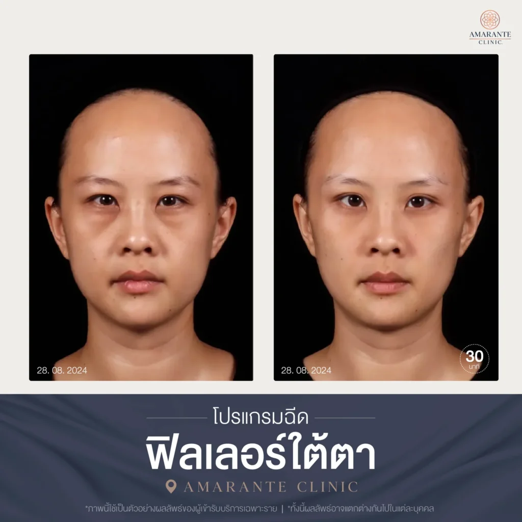 โปรแกรมฉีดฟิลเลอร์ใต้ตา-08-scaled