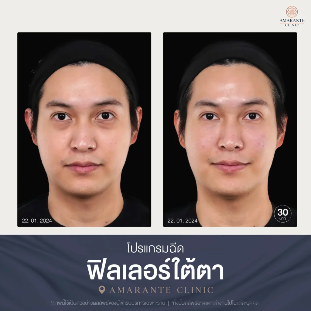โปรแกรมฉีดฟิลเลอร์ใต้ตา-09-scaled
