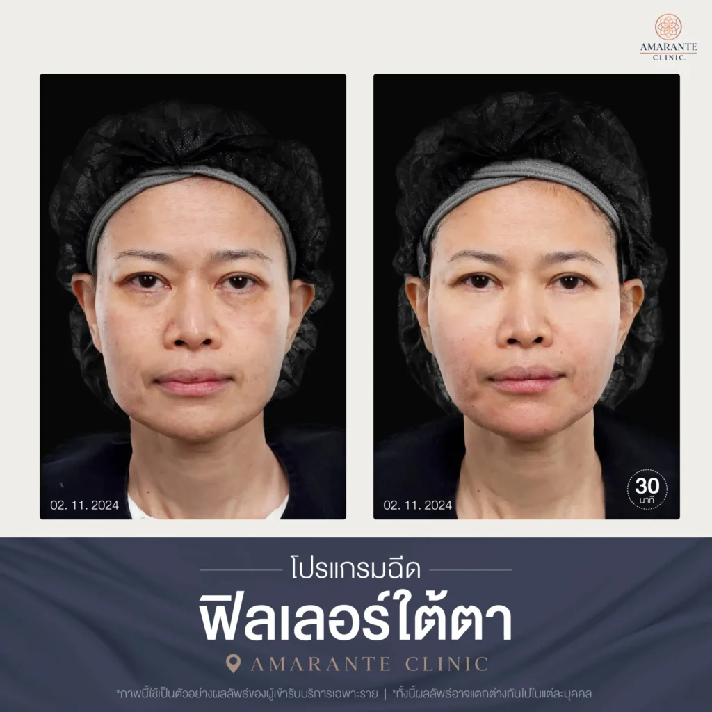 โปรแกรมฉีดฟิลเลอร์ใต้ตา-10-scaled