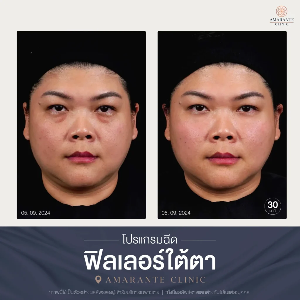 โปรแกรมฉีดฟิลเลอร์ใต้ตา-11-scaled