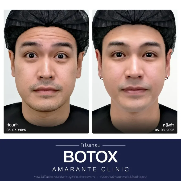 ภาพเปรียบเทียบ ก่อน หลัง ฉีดโบท็อก botox ภาพที่ 1
