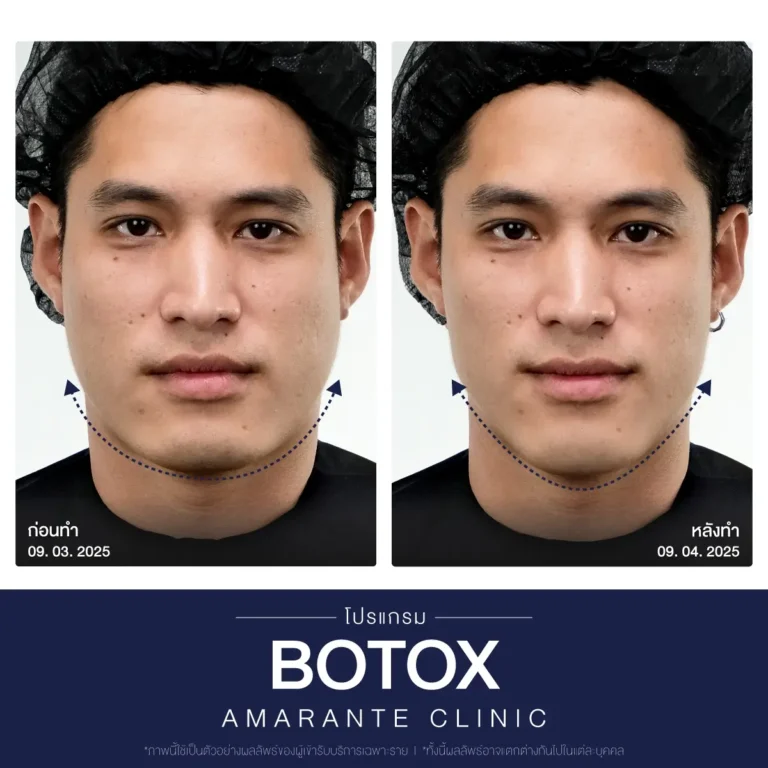 ภาพเปรียบเทียบ ก่อน หลัง ฉีดโบท็อก botox ภาพที่ 2