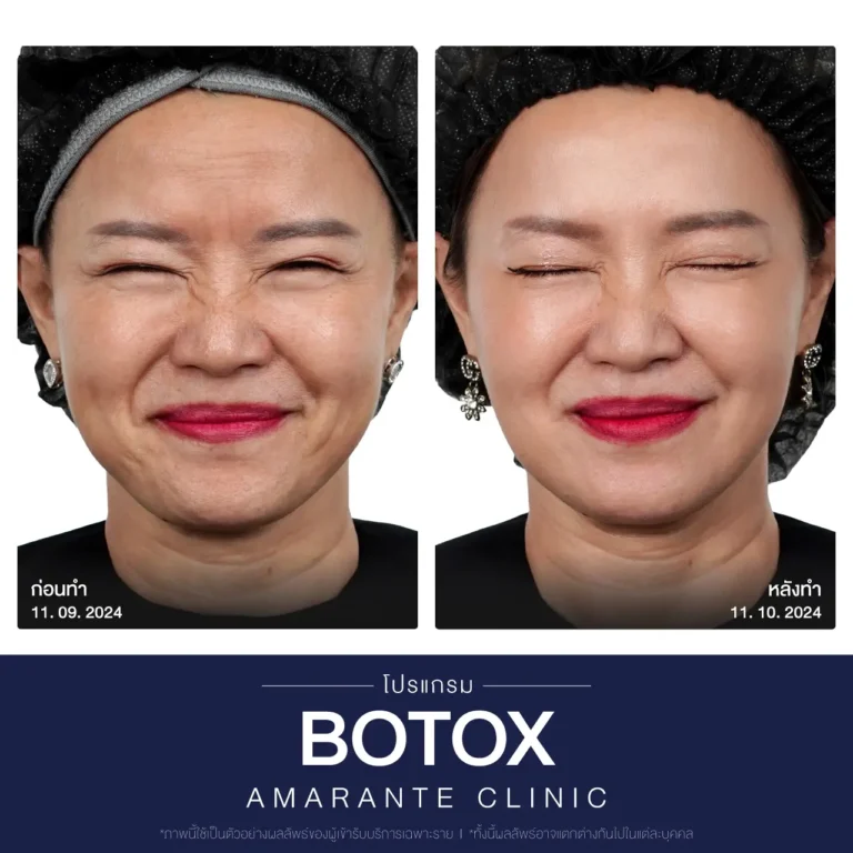 ภาพเปรียบเทียบ ก่อน หลัง ฉีดโบท็อก botox ภาพที่ 3