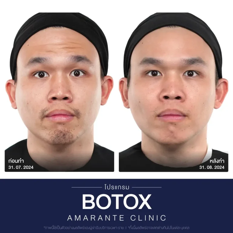 ภาพเปรียบเทียบ ก่อน หลัง ฉีดโบท็อก botox ภาพที่ 4