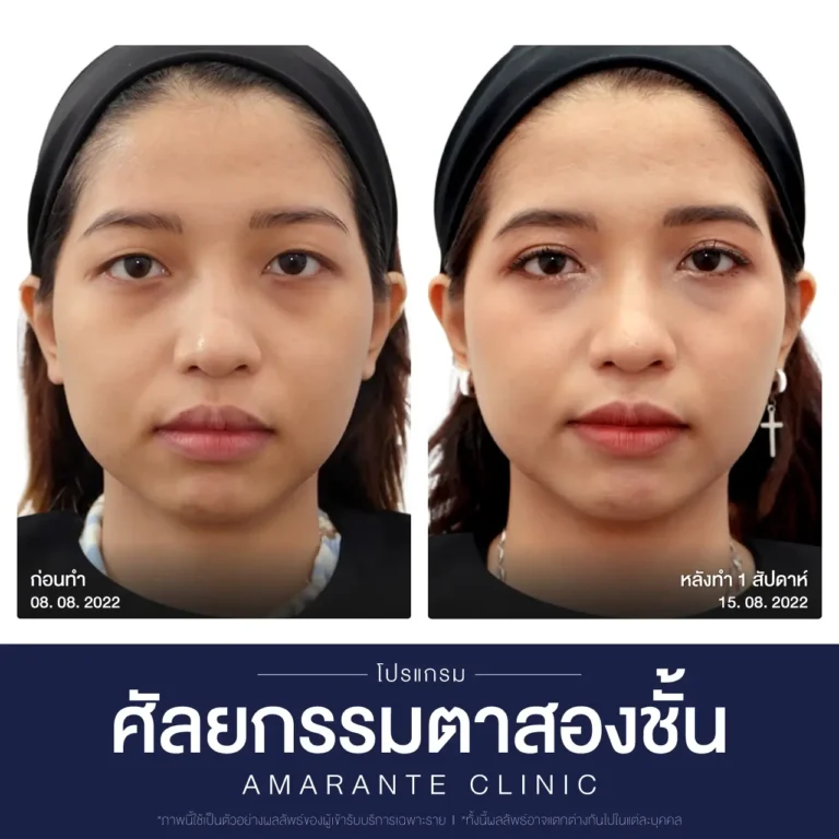 ภาพเปรียบเทียบก่อน หลัง ศัลยกรรมผ่าตัดตาสองชั้น 1