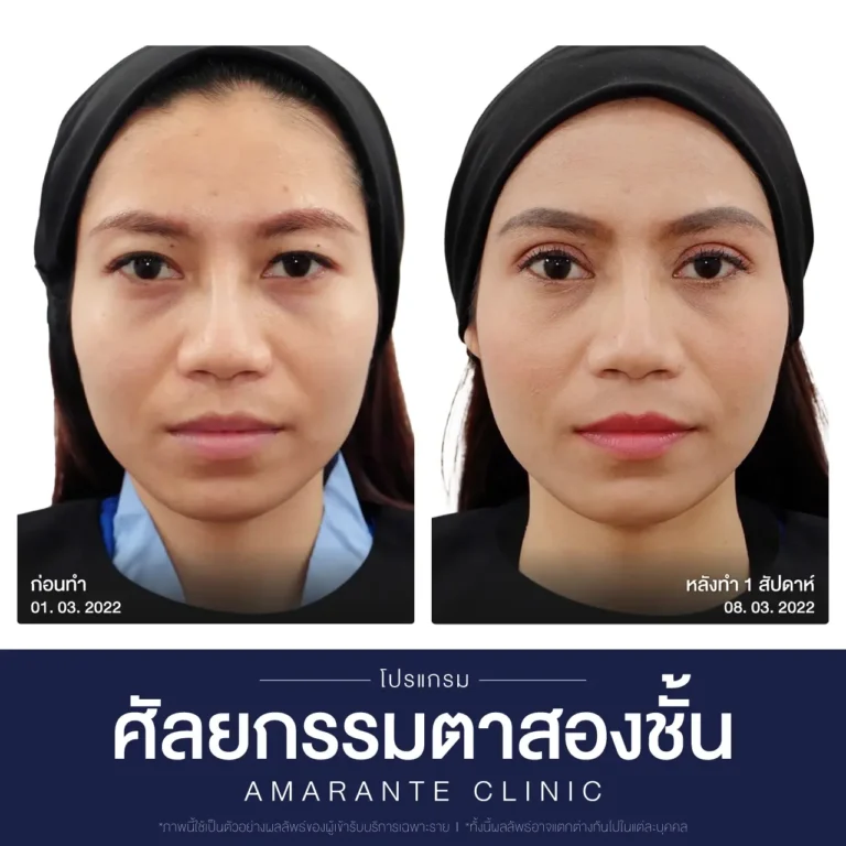 ภาพเปรียบเทียบก่อน หลัง ศัลยกรรมผ่าตัดตาสองชั้น 2