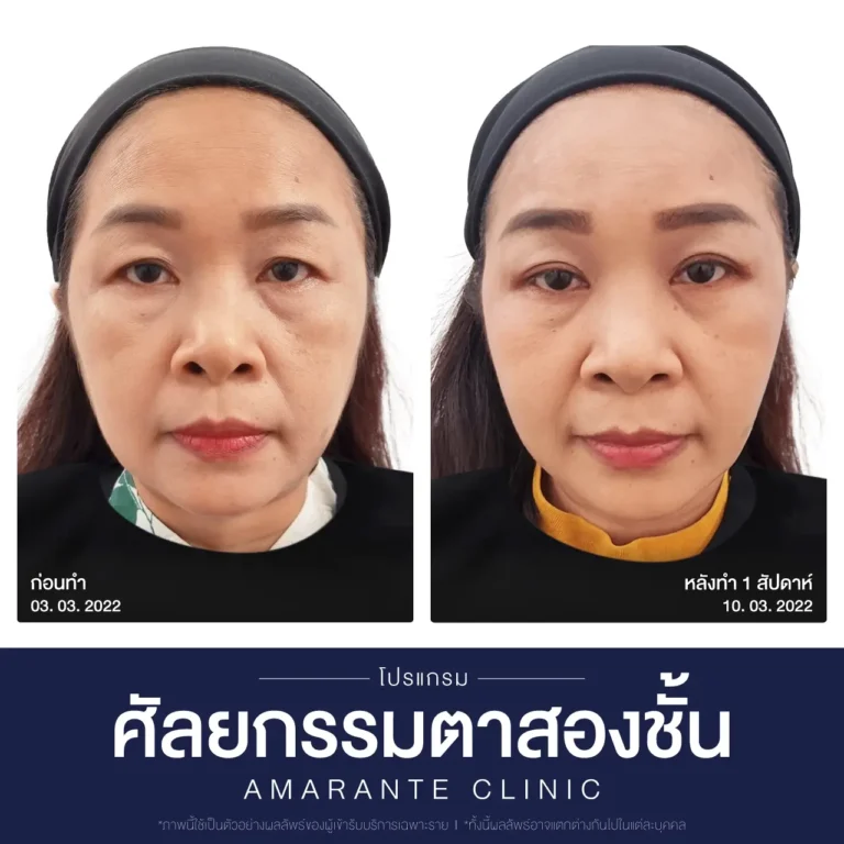 ภาพเปรียบเทียบก่อน หลัง ศัลยกรรมผ่าตัดตาสองชั้น 3