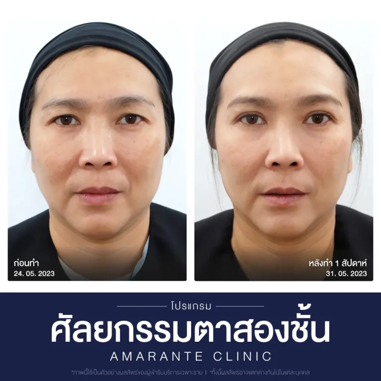 ภาพเปรียบเทียบก่อน หลัง ศัลยกรรมผ่าตัดตาสองชั้น 4