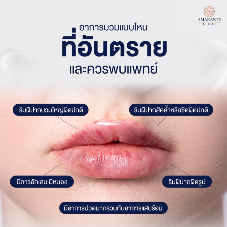 อาการบวมแบบไหนที่อันตรายและควรพบแพทย์
