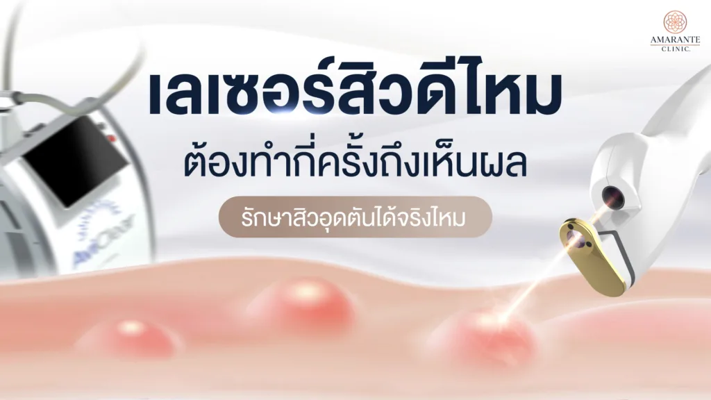 เลเซอร์สิวดีไหม ต้องทำกี่ครั้งถึงเห็นผล รักษาสิวอุดตันได้จริงไหม