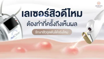 เลเซอร์สิวดีไหม ต้องทำกี่ครั้งถึงเห็นผล รักษาสิวอุดตันได้จริงไหม