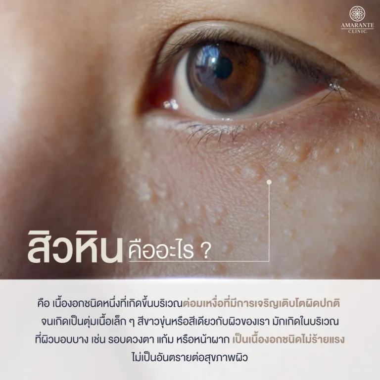 สิวหินคืออะไร
