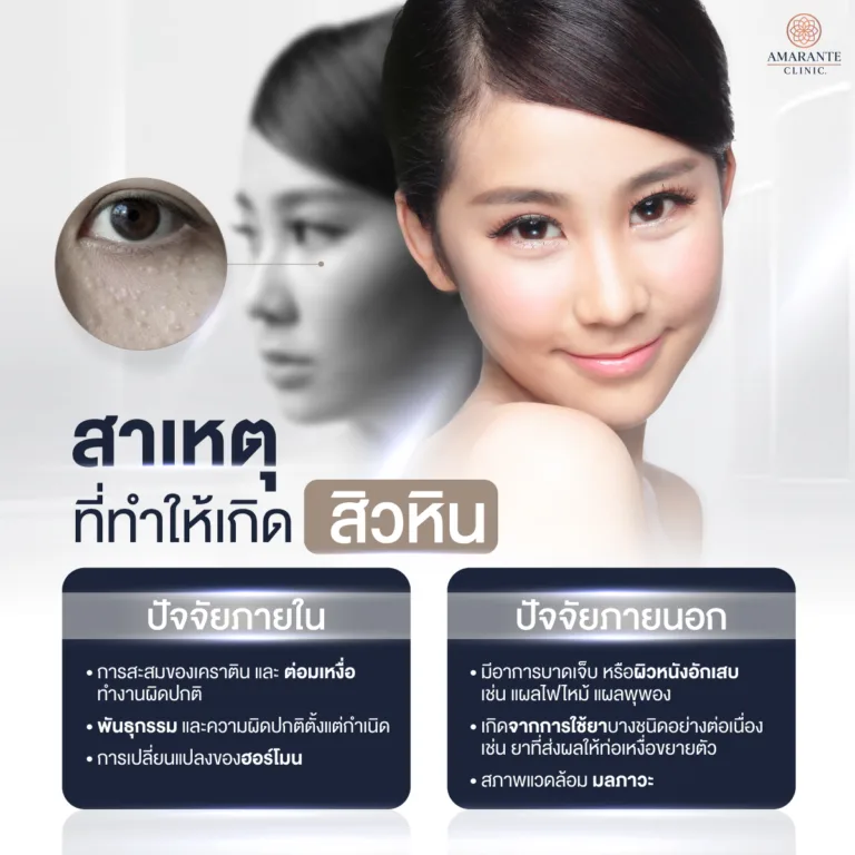 สาเหตุที่ทำให้เกิดสิว