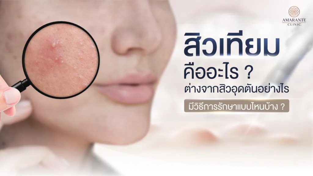 สิวเทียม