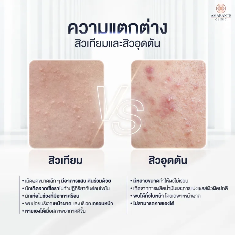 สิวเทียมต่างกับกสิวอุดตันยังไง