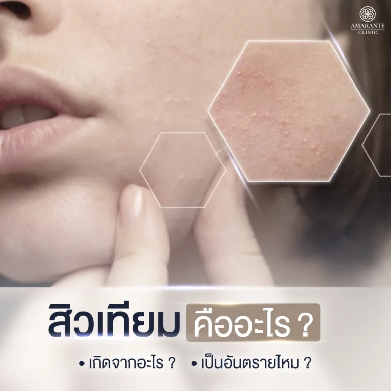 สิวเทียม