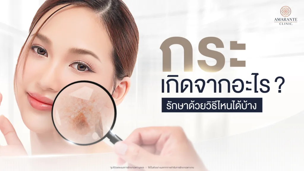 กระ เกิดจากอะไร รักษาด้วยวิธีไหนได้บ้าง