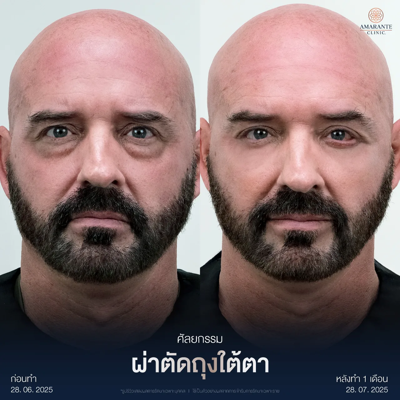 รีวิวผ่าตัดถุงใต้ตา5