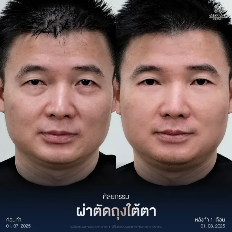 รีวิวผ่าตัดถุงใต้ตา7