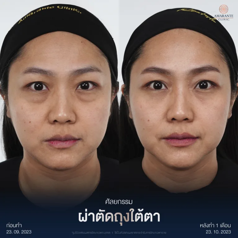 รีวิวผ่าตัดถุงใต้ตา8