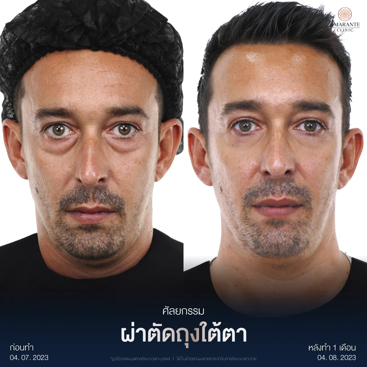 รีวิวผ่าตัดถุงใต้ตา3