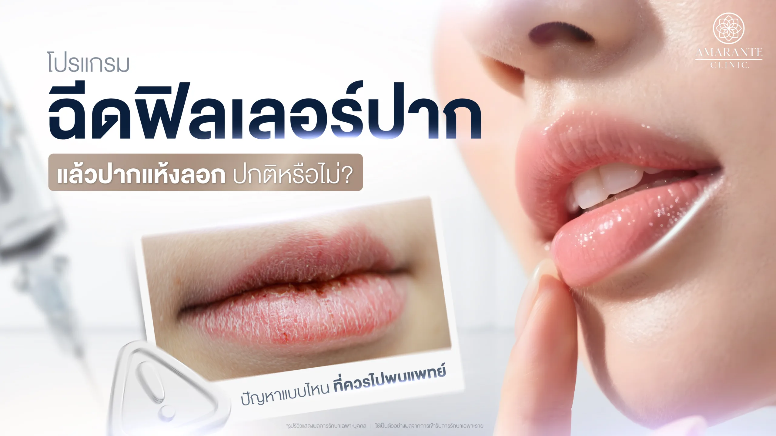 ฉีดปากแล้วปากแห้ง