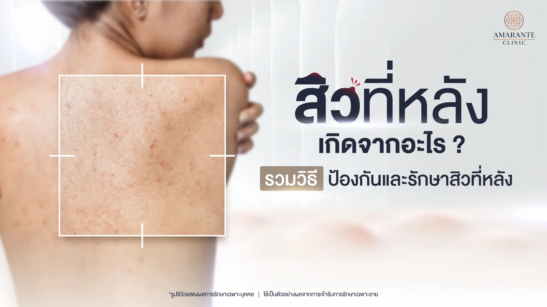 สิวที่หลังเกิดจากอะไร? รวมวิธีป้องกันและรักษาสิวที่หลัง