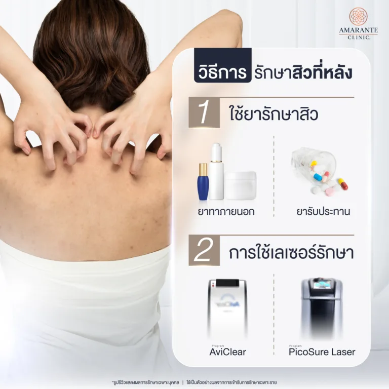 วิธีรักษาสิวท่หลัง