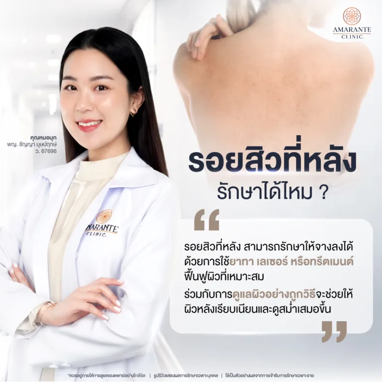 รอยสิวท่หลังรักษาได้ไหม