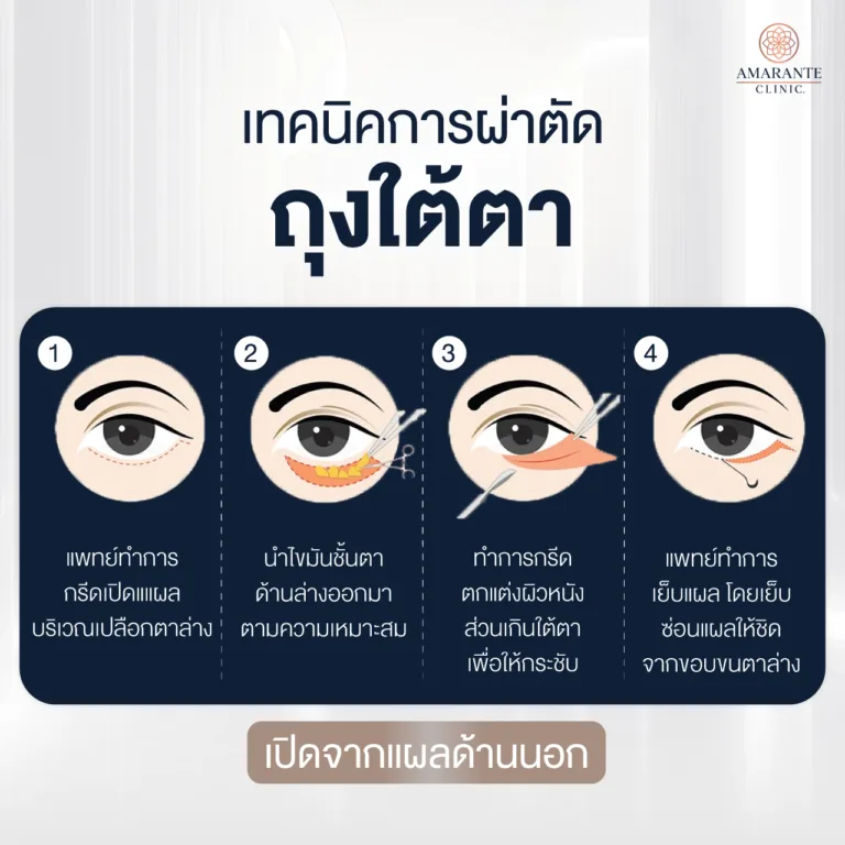 การผ่าตัดถุงใต้ตาแบบเปิดแผลนอก