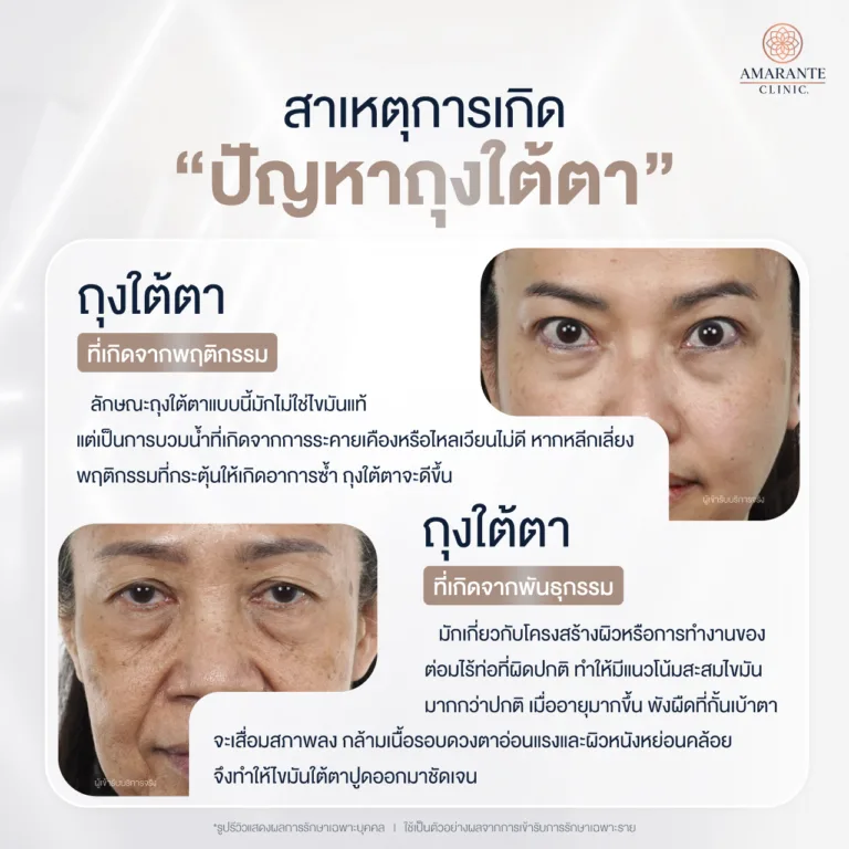 สาเหตุการเกิดปัญหาถุงใต้ตา