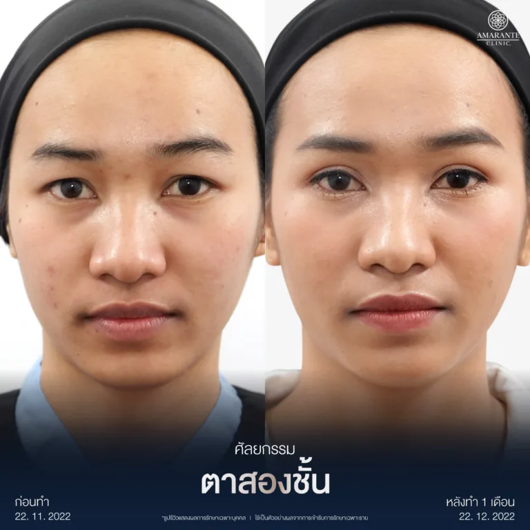 รีวิวแก้ไขตาสองชั้นหลบใน