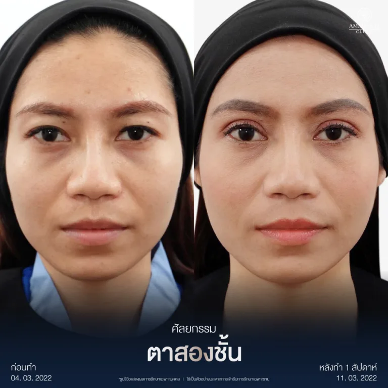 รีวิวตาสองชั้นแก้ไขตาสองชั้นหลบใบน