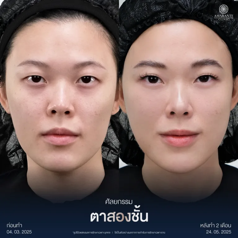 รีวิวศัลยกรรมตาสองชั้น