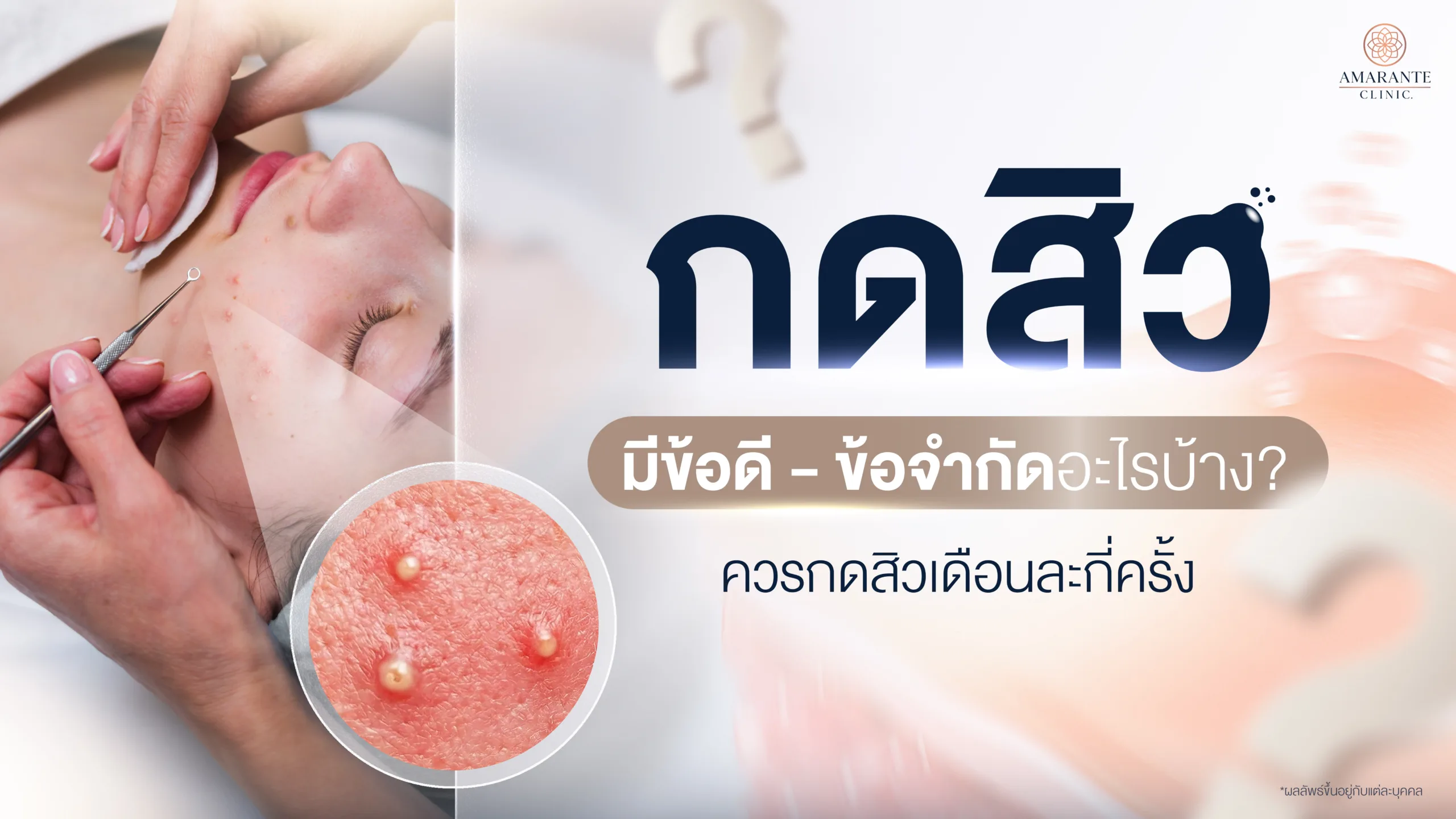 กดสิว คืออะไร? สิวแบบไหนที่ควรกด และแบบไหนที่ไม่ควรกด