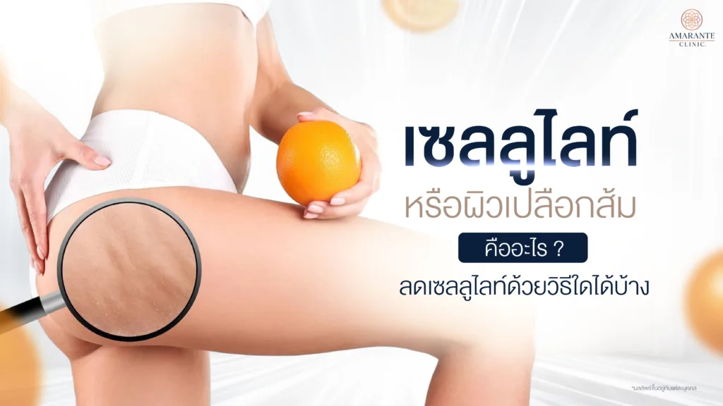 วิธีลดเซลลูไลท์ ซลลูไลท์ ผิวเปลือกส้มคืออะไร