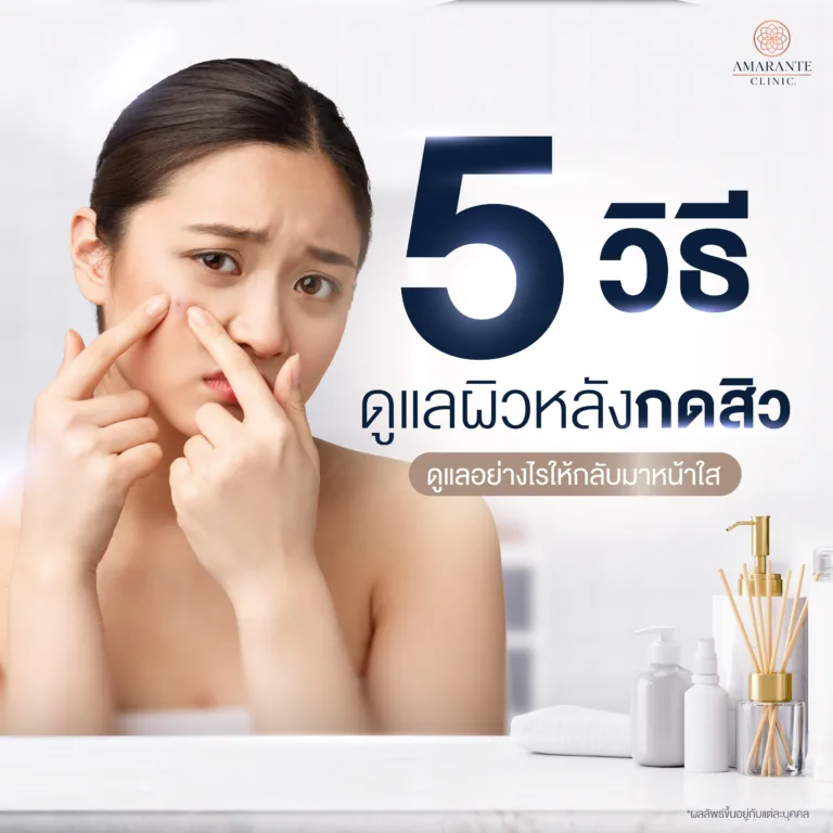กดสิวเสร็จควรทำอย่างไร