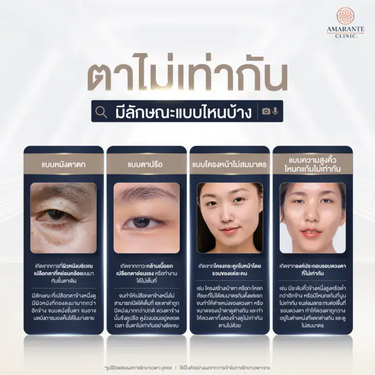 ลักษณะตาไม่เท่ากัน มีแบบไหนบ้าง?
