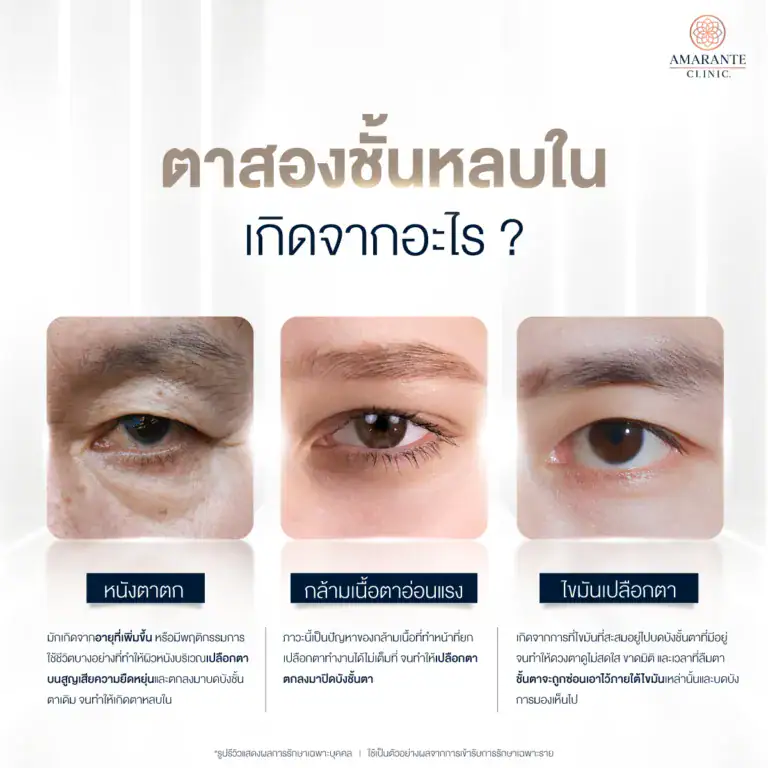 ตาสองชั้นหลบในเกิดจากอะไร?