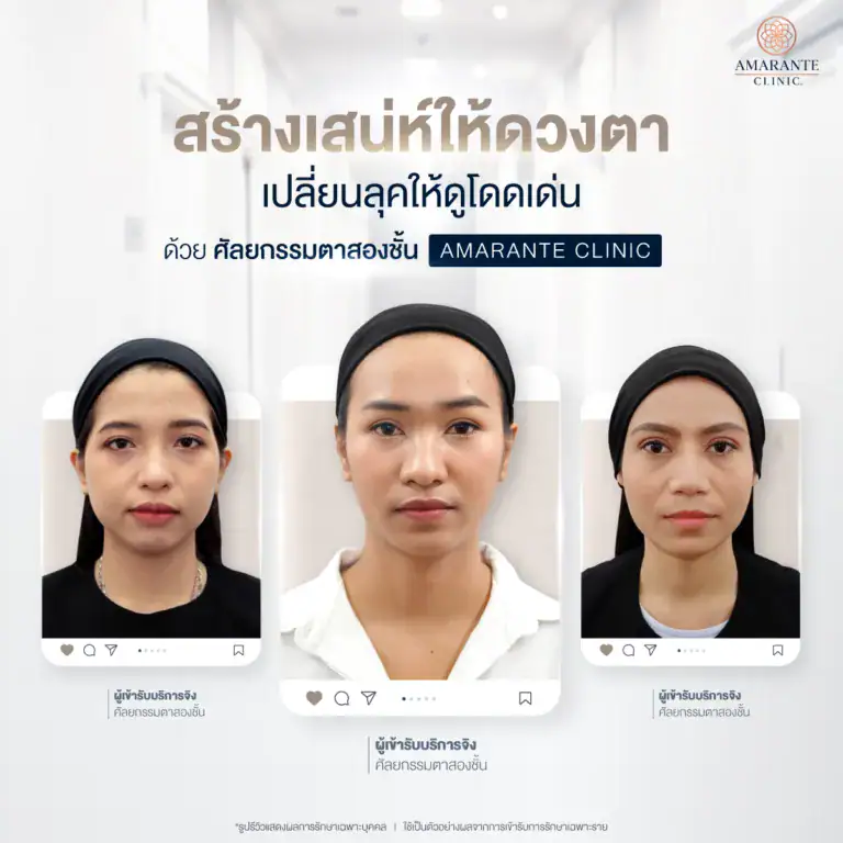 ศัลยกรรมตาสองชั้น ที่ Amarante Clinic
