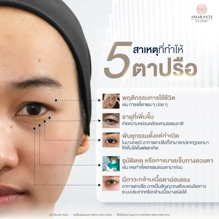 สาเหตุของตาปรือ เกิดจากอะไร