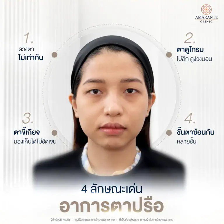 ลักษณะอาการตาปรือ