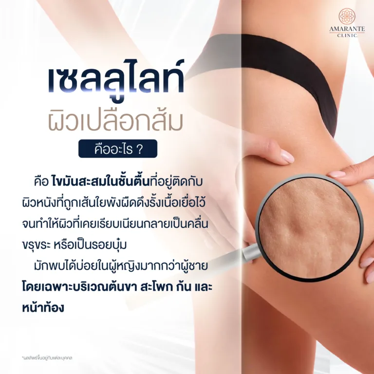 เซลลูไลท์ หรือ ผิวเปลือกส้มคืออะไร?
