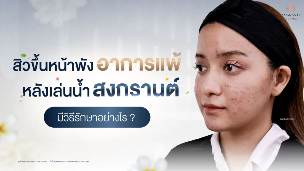 แพ้น้ำ สิวขึ้นหน้าพัง หลังเล่นน้ำสงกรานต์