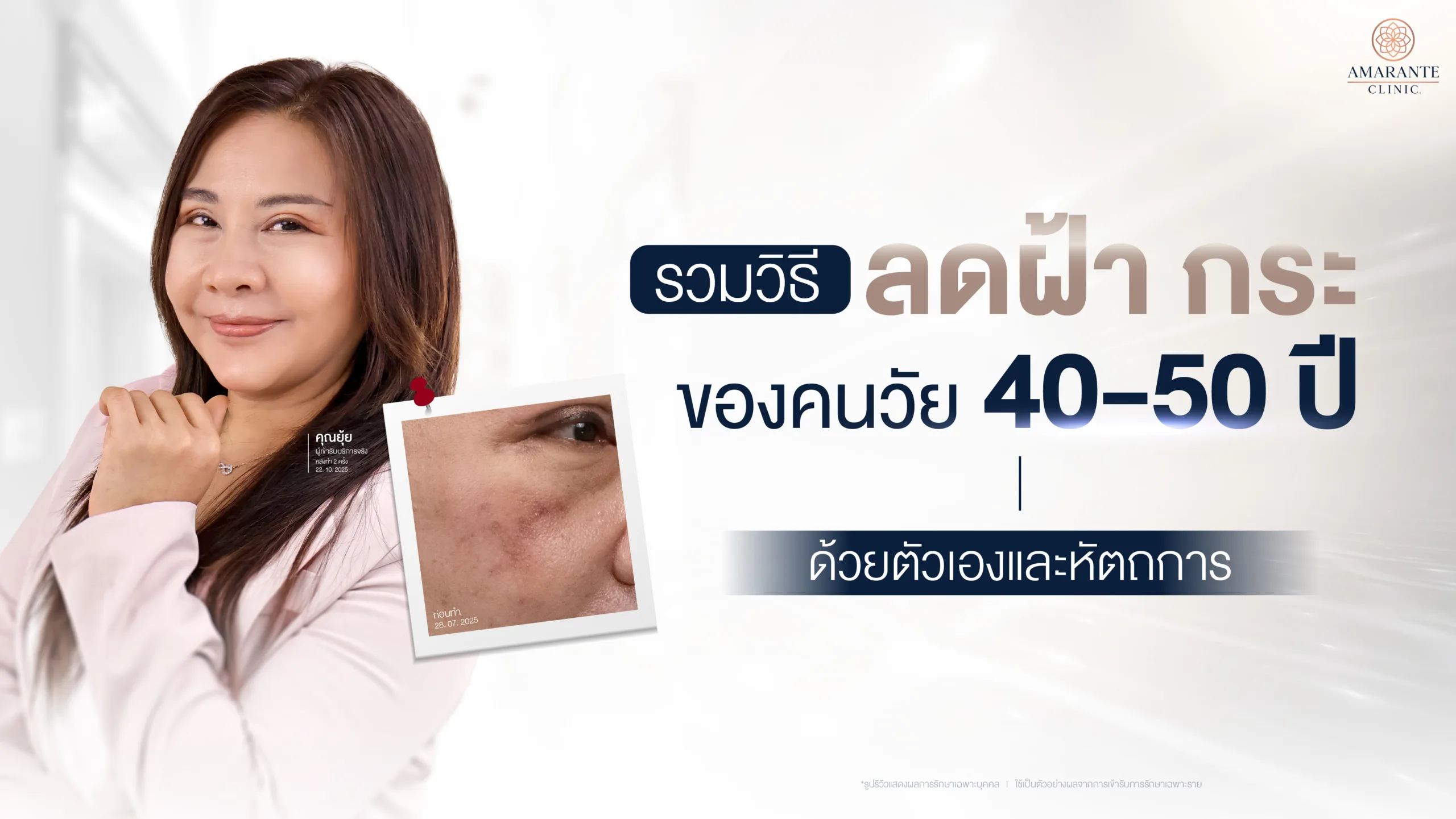 ฝ้า กระ ในวัยผู้สูงอายุ
