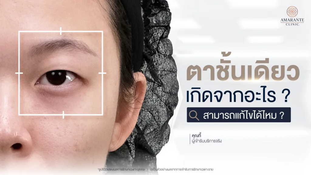 ตาชั้นเดียวแก้ไขยังไง ศัลยกรรมตาสองชั้น