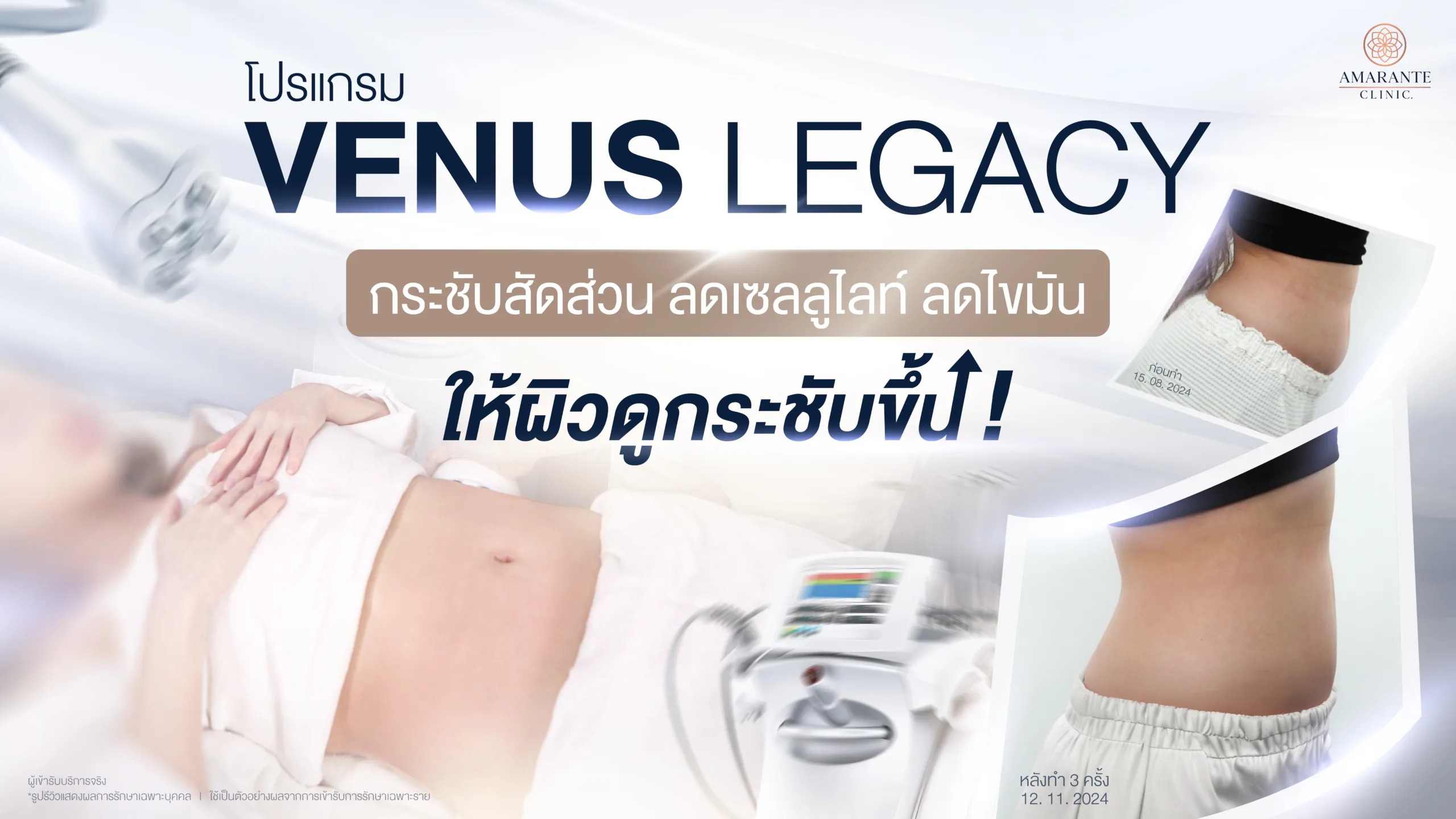 Venus Legacy คืออะไร? เครื่องช่วยลดเซลลูไลต์ ลดไขมันให้ผิวดูกระชับ