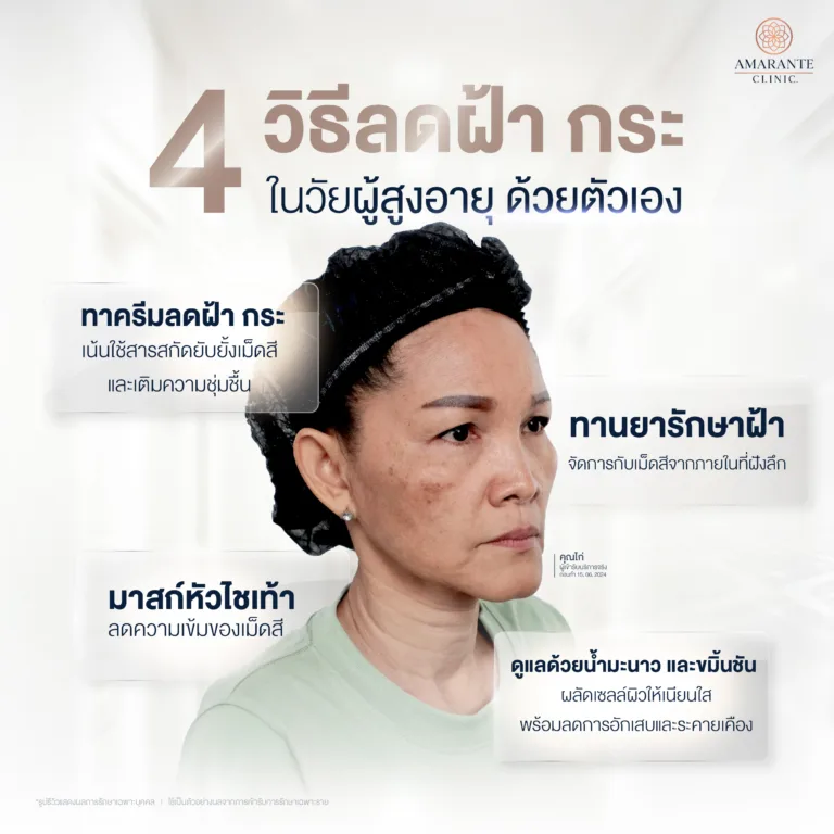 วิธีลดฝ้า กระ ด้วยตัวเองสำหรับคนอายุ 40-50 ปีขึ้นไป